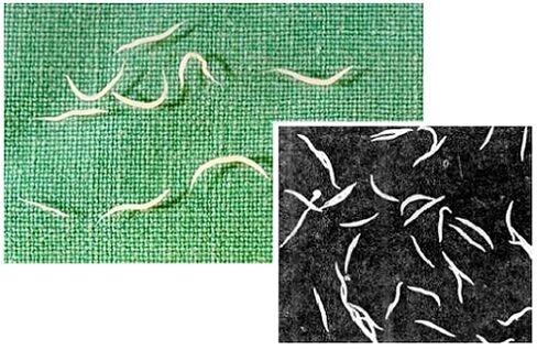 pinworms z ľudského tela