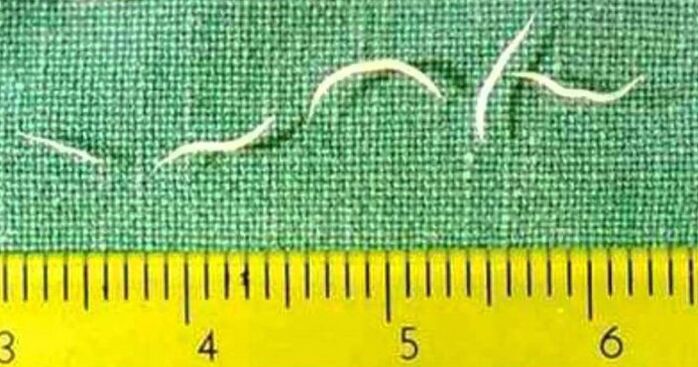 Pinworms sú najbežnejším typom červov u malých detí. 