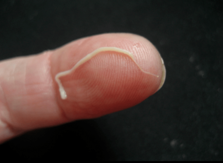 parazit škrkavky z ľudského tela